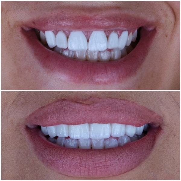 فينير الاسنان في قطر افضل دكتور ابتسامة هوليود في قطر